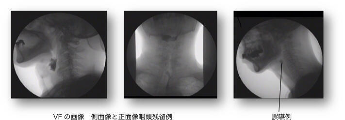 VFの画像、側面像と正面像咽頭残留例。誤嚥例。