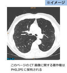 胸部CT画像の一部