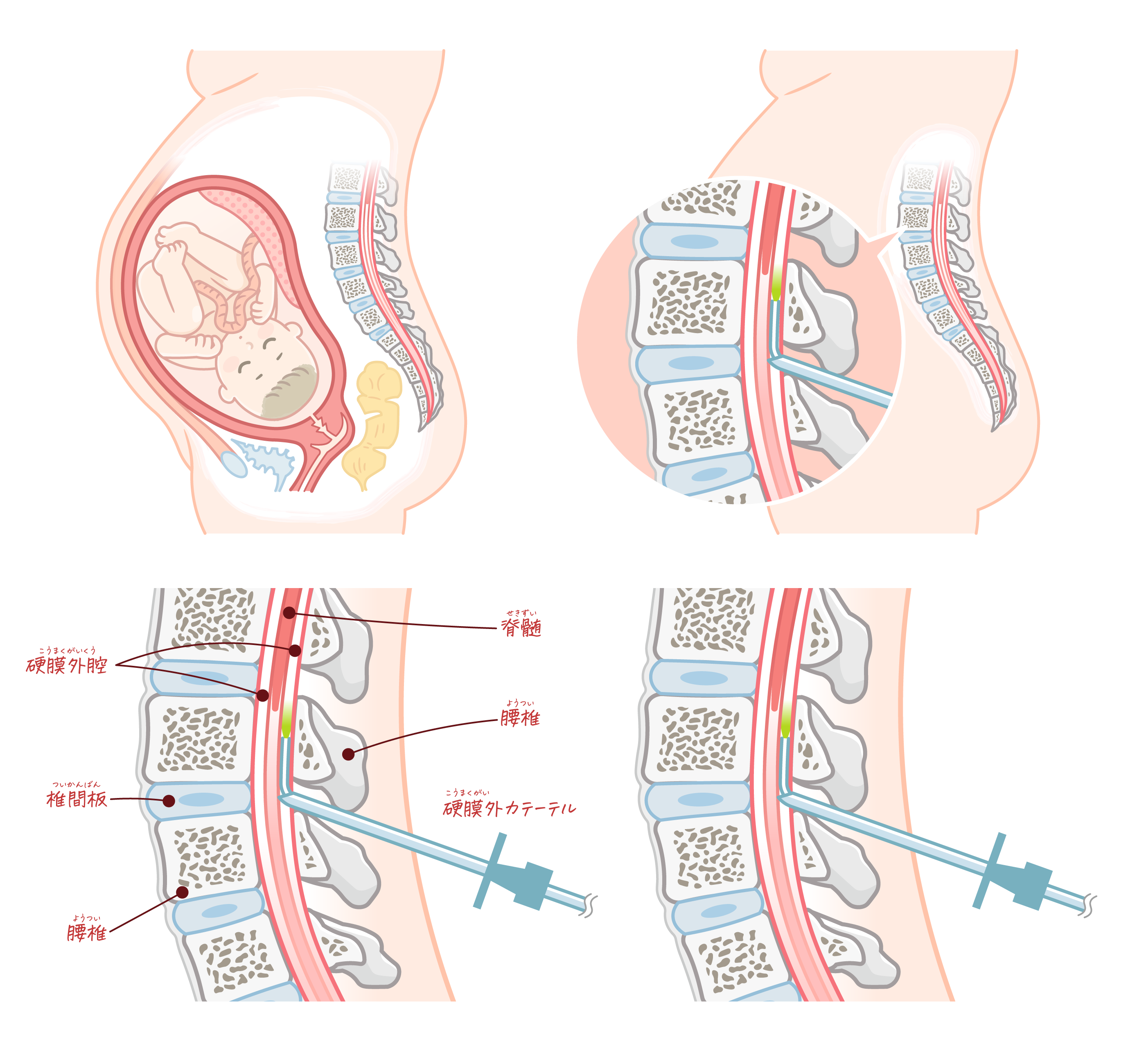 硬膜外麻酔とは