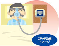 CPAP治療イメージ